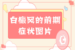 兰州安宁区哪家正规医院治疗白癜风较好