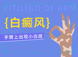 白点癫风多长时间能治好小孩子