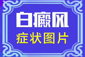 「预告」白点癫风是什么原因引起的病看血常规能看出来吗图片