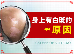 兰州城关区哪家医院治疗白癜风较好