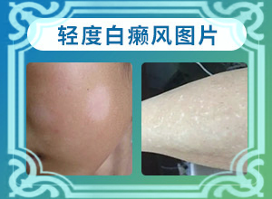 大人脸上有白块是怎么回事