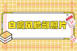 白殿病怎么医治[健康网]轻度白癞风饮食注意事项
