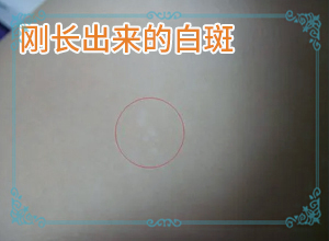 一岁宝宝脸上的白斑是什么引起的