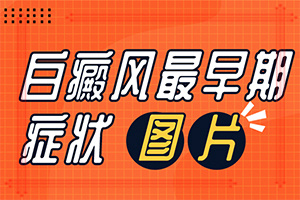 儿童白点癫风症状[热门盘点]白颠疯病是什么样的