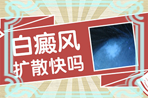 兰州安宁区治疗白癜风较好的医院在哪里