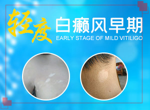 兰州安宁区有啥治疗白癫疯的专科医院吗