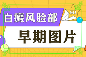 甘肃兰州白癜风专科医院哪家治疗好