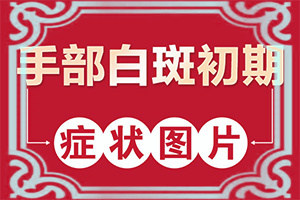 十个手指表皮移植治疗白颠费用多少