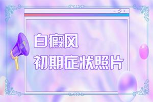 兰州榆中县哪家医院治疗白癜风正规服务好