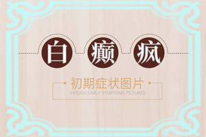 白癫疯由于缺乏哪种微量元素引起