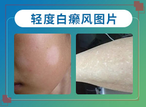 兰州城关区哪个医院哪个治疗白癜风好