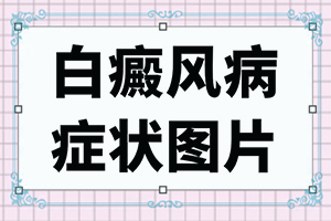 白点癫风的中药涂多久有效