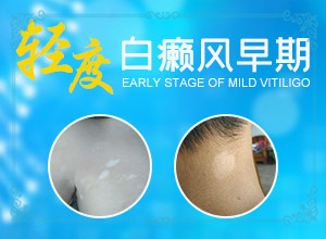 皮肤长白斑是什么原因引起的,怎么治疗