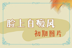 儿童白点癫风早期症状表现