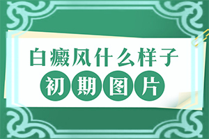 白颠有什么好法子治疗呢