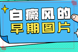 兰州城关区较好的白癜风专科治疗医院检查
