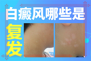 白点癫风能自愈[皮肤科筛选]治白癫选择哪家好