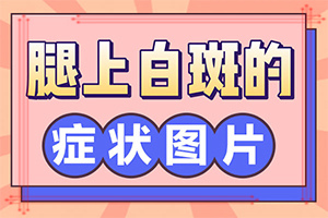 兰州安宁区哪家治白癜风的医院较好