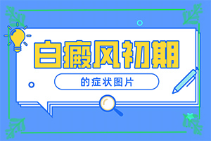 兰州市哪家医院白癫疯治的好