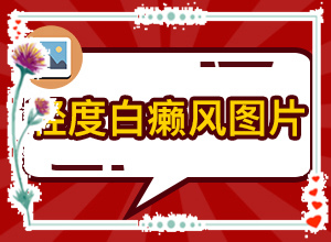 兰州治疗白癜风的好的医院排名