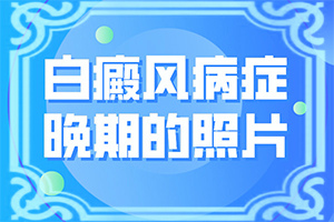 2岁多小孩脸上长小块白斑是什么原因