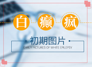 兰州白癜风检查哪个医院好