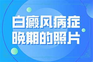 轻度白癞风治愈不复发的案例有哪些
