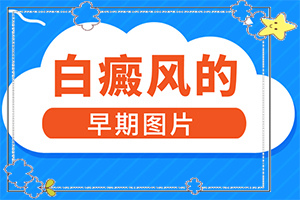 兰州安宁区哪家医院治疗儿童白癜风较好