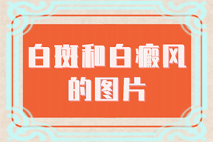白点癫风会遗传几率大吗女性怎么治