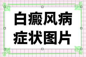 白癜风兰州七里河区医院治疗费用是多少