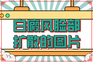 兰州红古区哪家医院治疗白癜风好啊