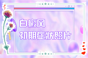兰州高新区有哪些白癜风医院有优惠政策