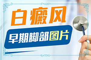 兰州皋兰县白癜风治疗到哪家医院非常好
