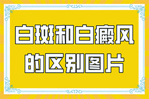 白点癫风多发于哪些部位图片