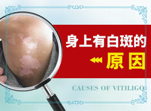 宝宝白颠疯病初期怎么诊断