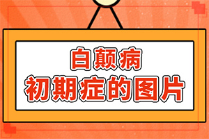 兰州哪家治白癜风比较强【患者放心】