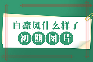 白癜风初期症状[排行榜单]小孩子白颠疯病初期