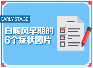 兰州高新区白癜风专科医院多久才能白癜风