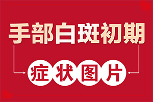 兰州城关区能白癜风的专科医院那个好