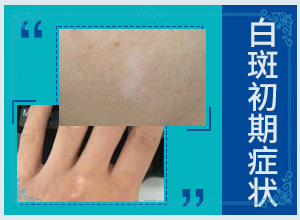 小孩身上起白色斑点,是什么原因引起的