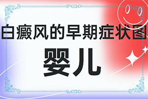 儿童白颠初期在头部好治疗吗