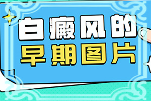 儿童早期白点癫风能控制吗图片