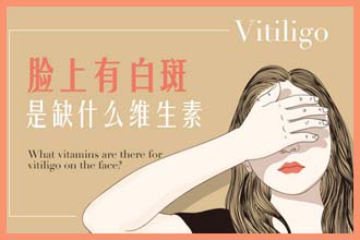 白癞风一般多久可以治好