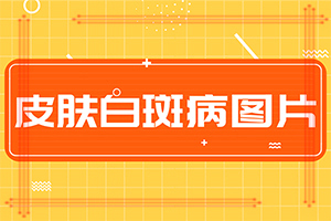 「公开推荐」皮肤白块是什么原因-小孩为什么会长白巅峰