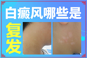 兰州皋兰县<a href=/ target=_blank class=infotextkey>白癜风专科医院</a>哪家治疗好