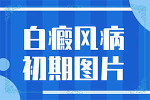 兰州治疗白癜风哪家医院可以相信