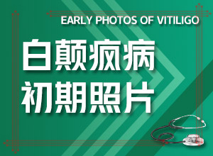 甘肃兰州治疗白癜风较好的医院是哪家医院