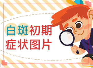 兰州榆中县哪家白癜风医院治疗白癜风较好