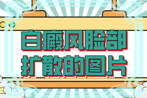 兰州正规治疗白癜风的医院是哪家