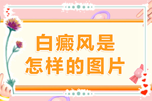 兰州治疗白癜风费用咨询(检查白斑需要多少钱)
